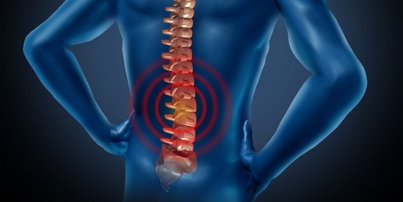 Lumbar osteochondrosis