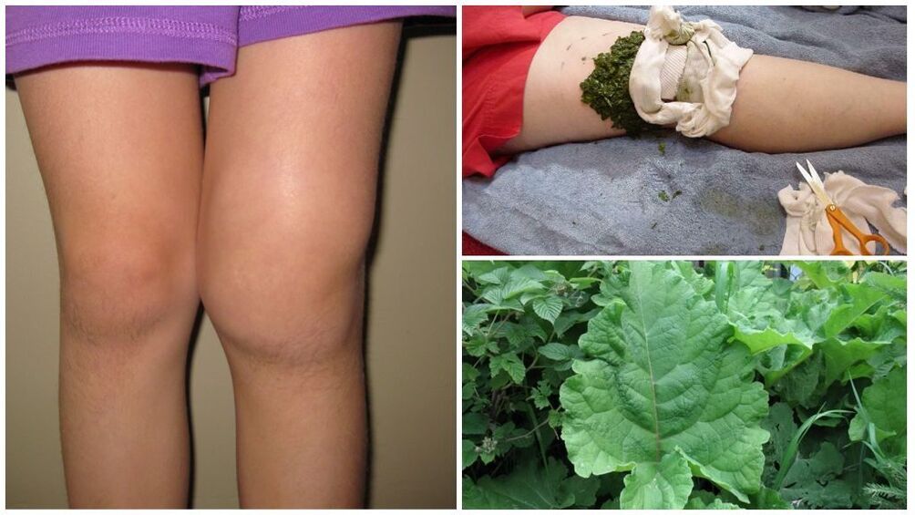 Knee compress with burdock - a popular method for treating gonarthrosis