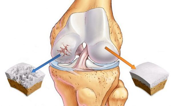 Osteoarthritis of the knee joint (left) and normal cartilage (right)