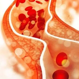 Deposition of cholesterol on the inner walls of blood vessels causes pain in the side of the neck